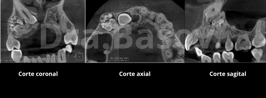 Odontoma dental corte axial, sagital y coronal del odontoma dental presentado.